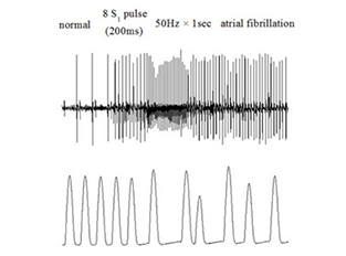 Atrial fibrillation...